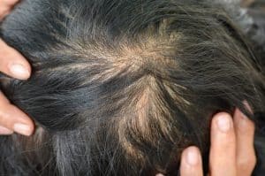 راه های جلوگیری از ریزش مو در خانم ها - آرکاشاپ