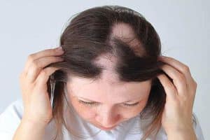 درمان ریزش مو سکه ای - ارکا شاپ